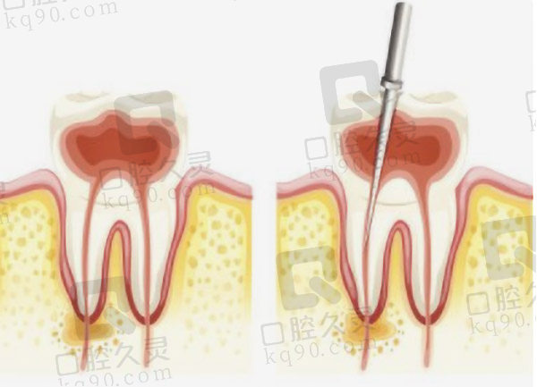 根管治疗2