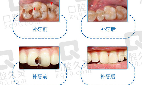 补牙技术实物图