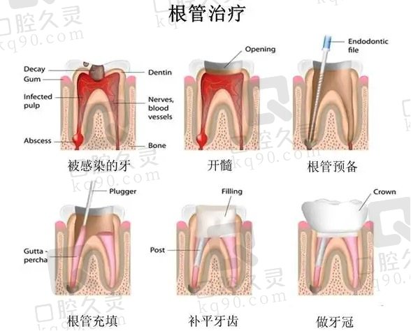 根管治疗步骤