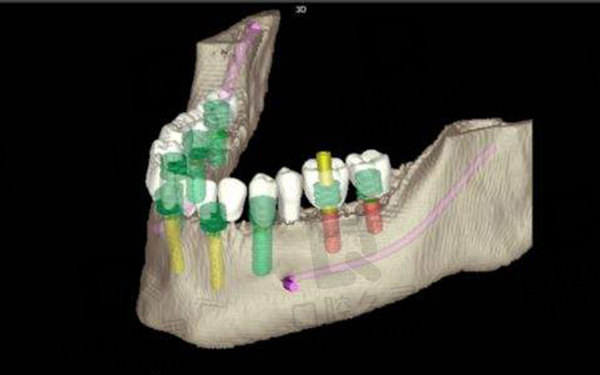 3D导板种植牙