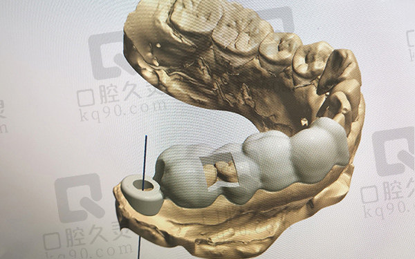 3D导板种植牙