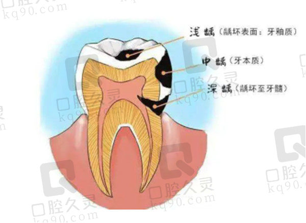 牙齿龋坏程度