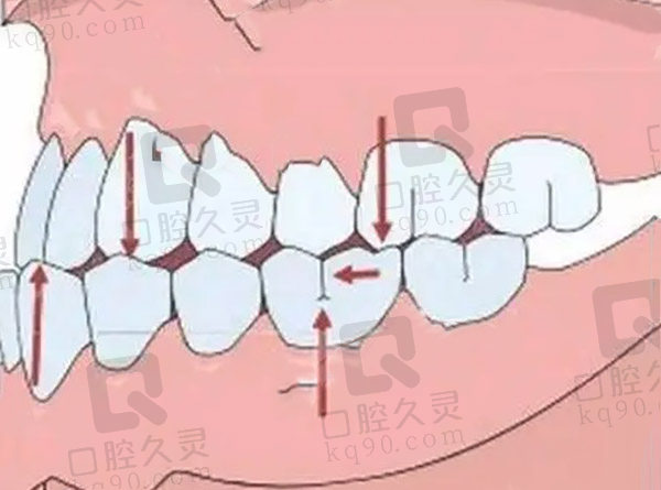 地包天导致咬合不正