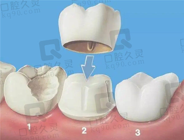 牙冠修复过程