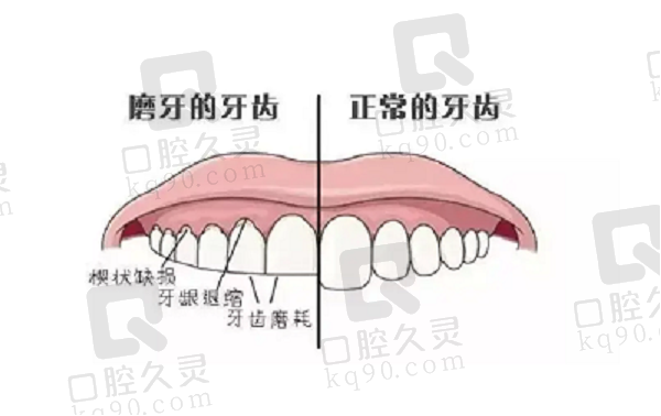 磨牙牙齿与正常牙齿对比