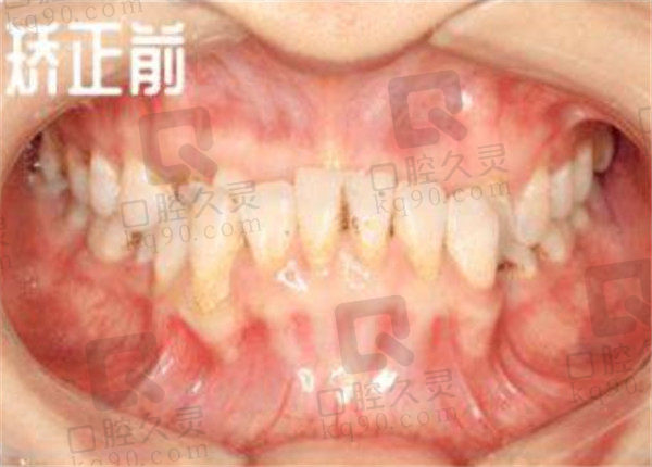 骨性地包天诊疗前牙齿状态