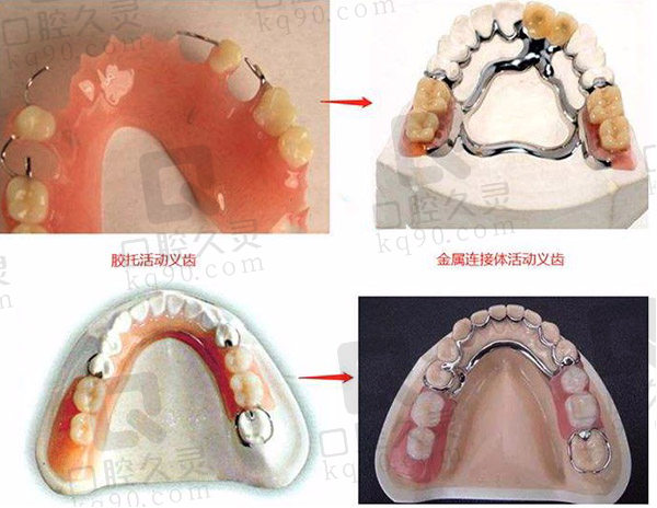 活动义齿种类