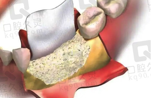种植牙骨粉填充示范