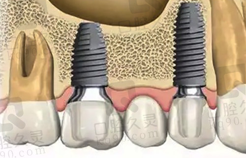 多颗牙齿种植示范图