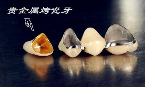 贵金属烤瓷牙