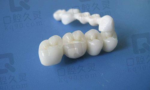 全瓷牙优点与缺点