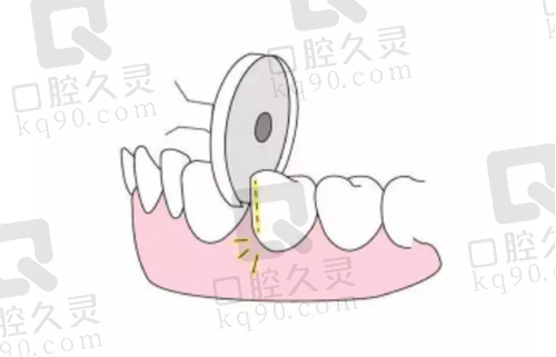 牙齿片切