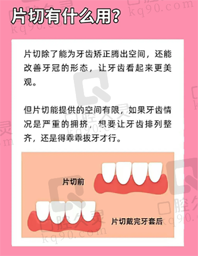 牙齿片切有什么用