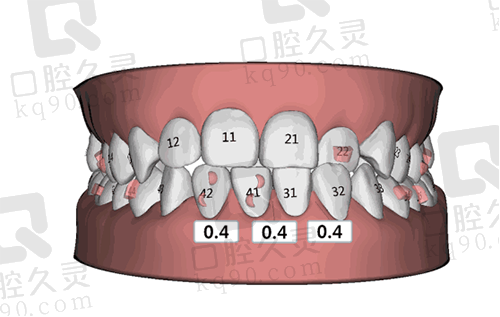 磨牙量