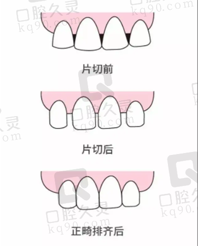 正规的牙齿片切前后对比