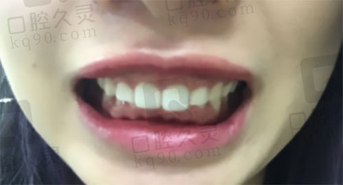 深覆合