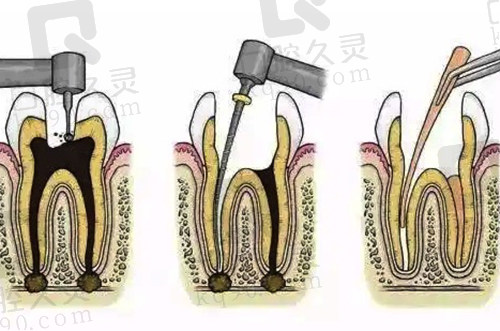 牙齿深龋根管治疗示意图