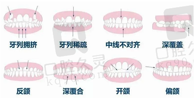 需要矫正的牙齿类型