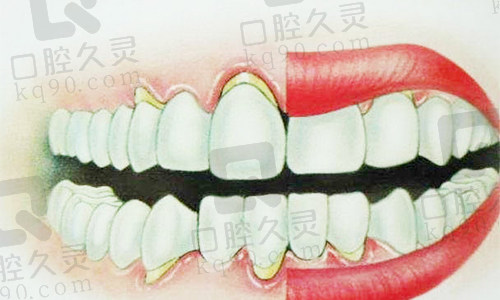 牙龈萎缩图