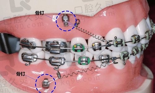 骨钉通常在这个正畸阶段进行