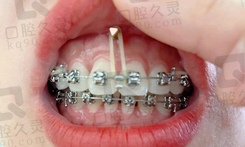 骨钉要戴多久