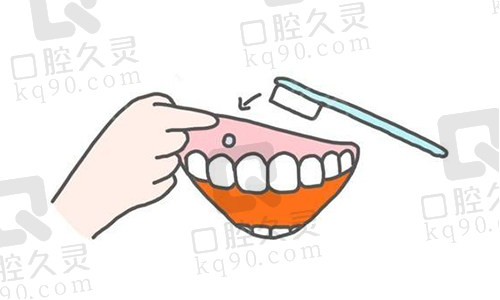 正畸骨钉清洁
