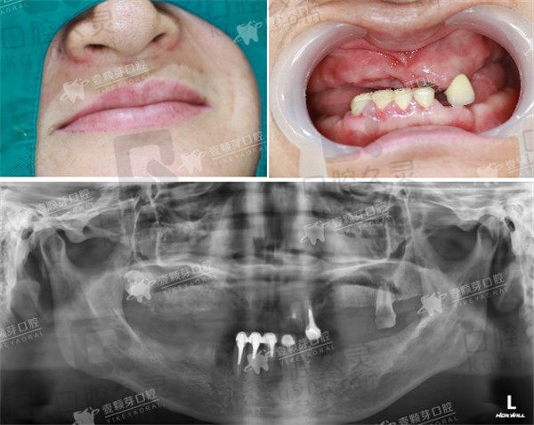 烟台壹颗牙口腔全口种植牙术前