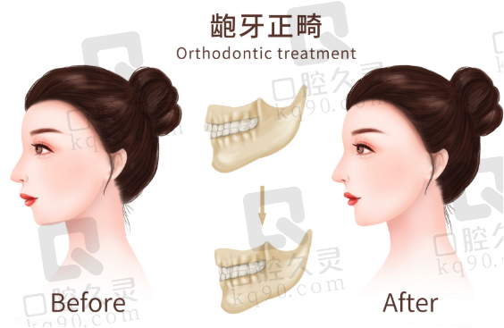 佩戴保持器很重要