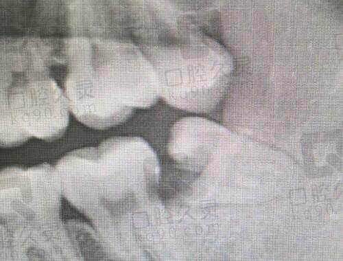 近中阻生牙齿