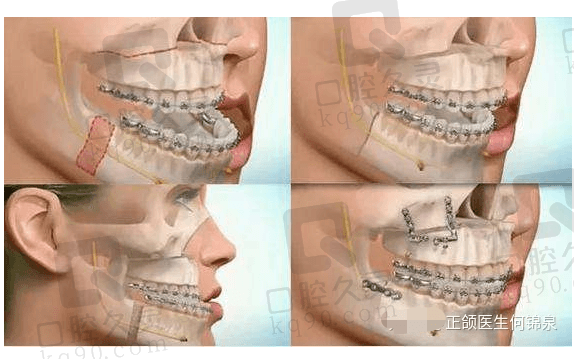 广大口腔正颌正畸联合治疗