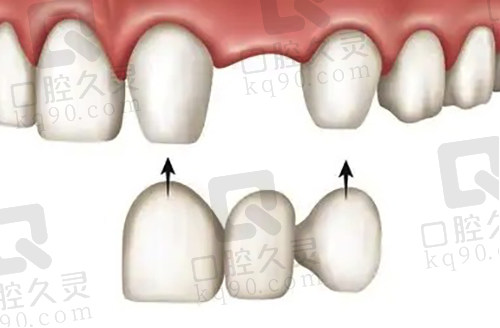 烤瓷桥牙齿单颗修复