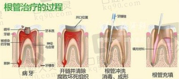 根管治疗