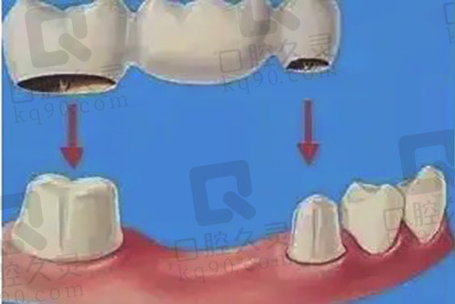 固定义齿修复方式
