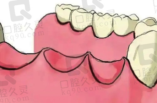 牙齿缺失卡通示范图