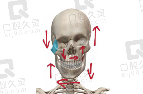 骨性偏颌