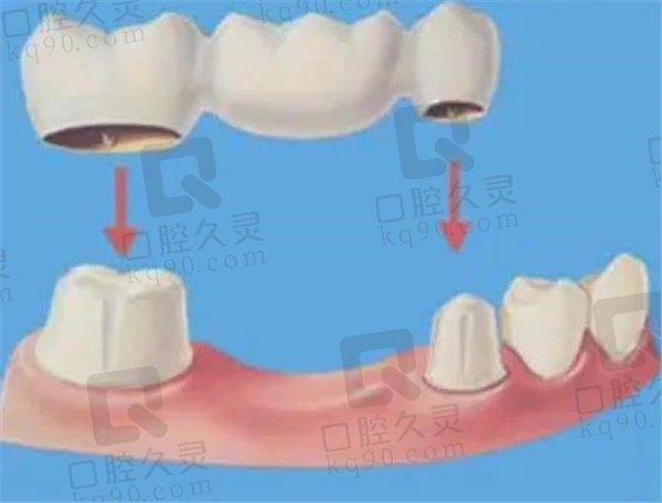 烤瓷牙修复方式