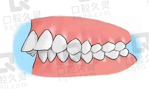 正畸越整嘴越凸