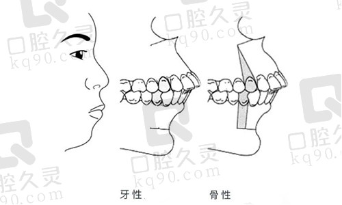 龅牙牙性突出和骨性突出