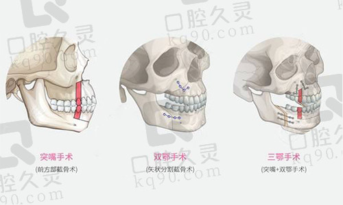 骨性凸嘴正颌手术