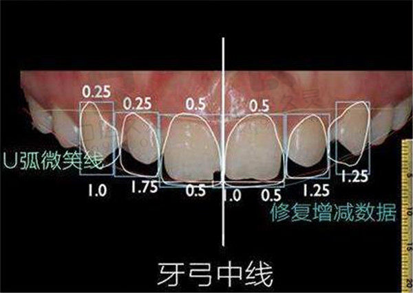 刘惟嵩牙齿矫正笑线设计