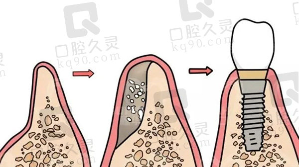 种植牙过程