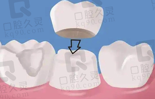 根管治疗后通过牙冠保护