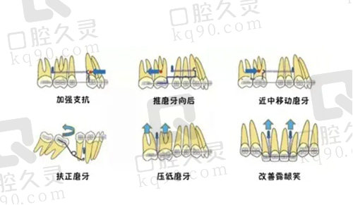 骨钉对于矫正的作用