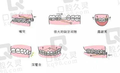 骨钉对于疑难矫正的帮助