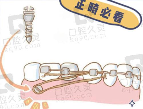 正畸打骨钉的注意事项