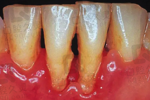 牙周炎疾病牙龈萎缩现象