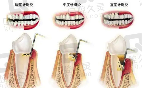 不同牙周炎程度示范图