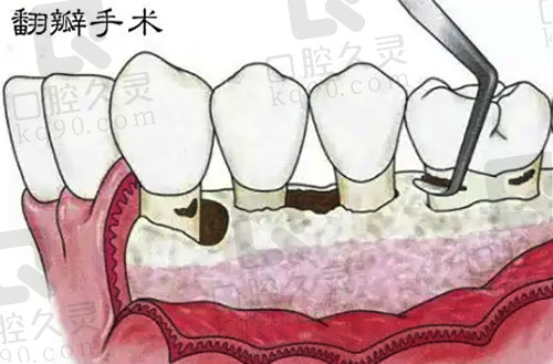 重度牙周炎翻瓣手术示范