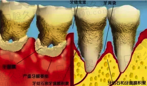 牙周炎疾病详细图解