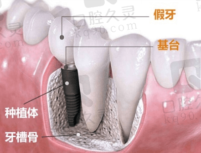种植牙的构成